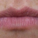 BEFORE JUVEDERM